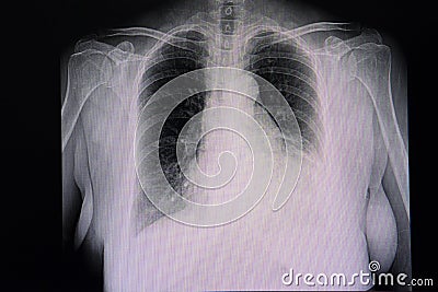 cardiomegaly and left pleural effusion Stock Photo