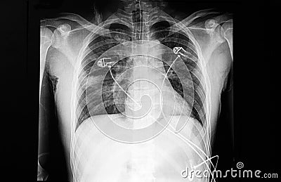 Chest X ray film of a patient with dyspnea Stock Photo