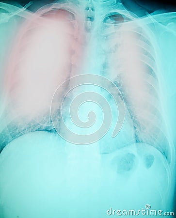 Chest x-ray foe lung infection Stock Photo