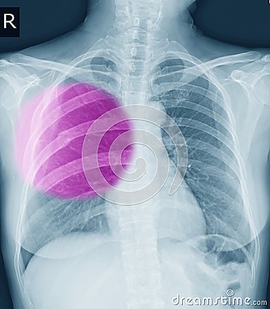 Chest x-ray Fracture right posterior 6th rib and possible fracture lateral aspect of left 9th rib Stock Photo