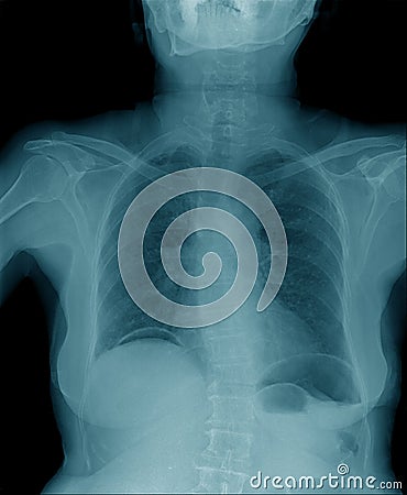 Chest x-ray , hight quality chest x-ray image Stock Photo