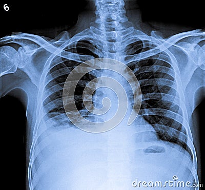 Chest X Ray of human body with right plural effusion. Stock Photo