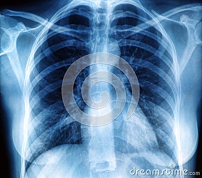 Chest X-ray image Stock Photo