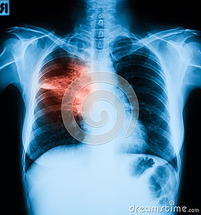 Chest X-ray image, PA upright position. Stock Photo