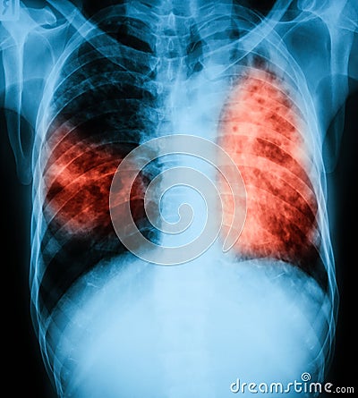 Chest x-ray image of a patient with pulmonary tuberculosis. Stock Photo