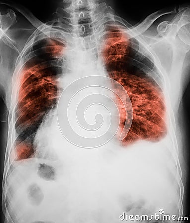 Chest x-ray image showing lungs infection. Stock Photo