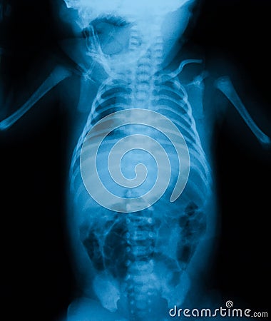 Chest X-ray include abdomen. Stock Photo