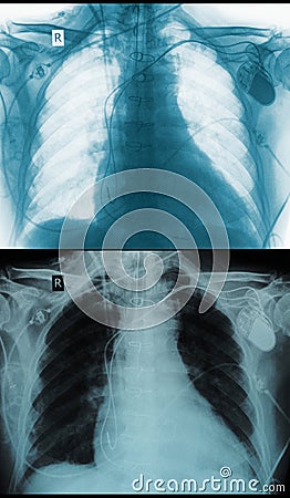 Chest X-ray picture negative positive Stock Photo
