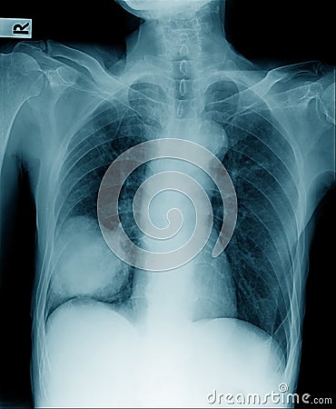 Chest x-ray lobectomy Stock Photo