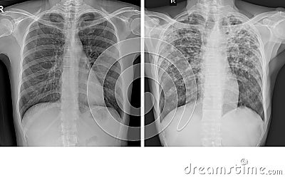 Chest x-ray Showing Normal chest and Pulmonary Tuberculosis TB Stock Photo