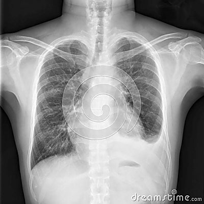 Chest X-ray shows cardiomegaly with infiltration and loculated pleural effusion Stock Photo