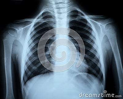 Chest xray Stock Photo