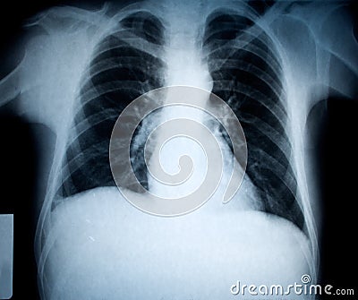 Chest xray Stock Photo