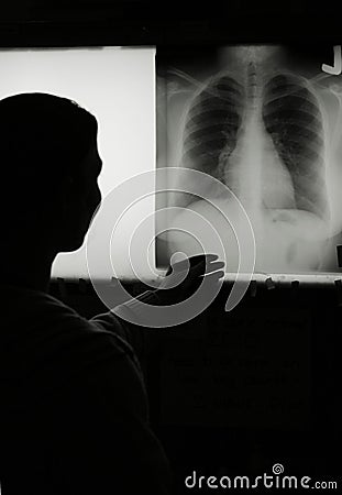 Chest Xray Stock Photo