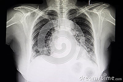 A chest xray film of patient with heart failure Stock Photo