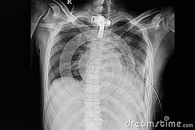 icd 10 contusion thorax