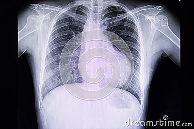 chest xray film of a patient with right ventricular hypertrophy Stock Photo