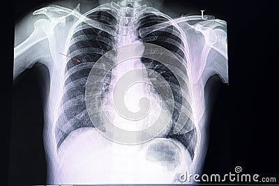 small nodule in the lung Stock Photo