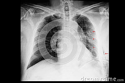 a chest xray of a patient with rib fractures and pleural effusion and subcutaneous emphysema Stock Photo