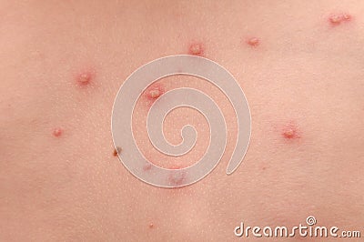 Chickenpox Stock Photo