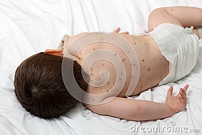 Chickenpox and baby Stock Photo