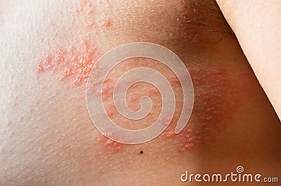 Chickenpox rash. Shingles, varicella-zoster virus. skin rash and blisters on body. Skin infected Herpes zoster virus Stock Photo