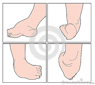 Child with club foot Vector Illustration