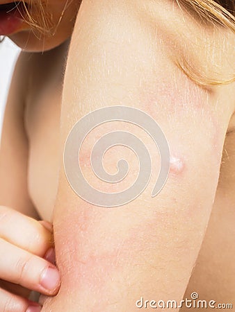 Child with hive, rash, skin abnormality Stock Photo