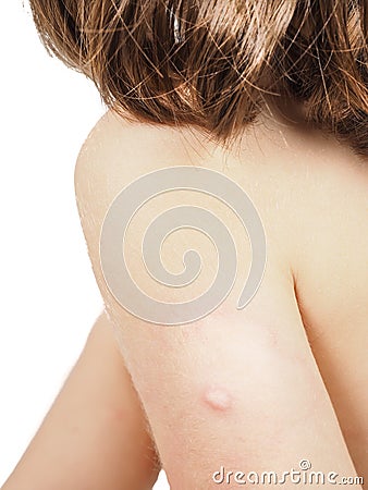 Child with hive, rash, skin abnormality towards white Stock Photo