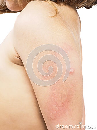Child with hive, rash, skin abnormality towards white Stock Photo