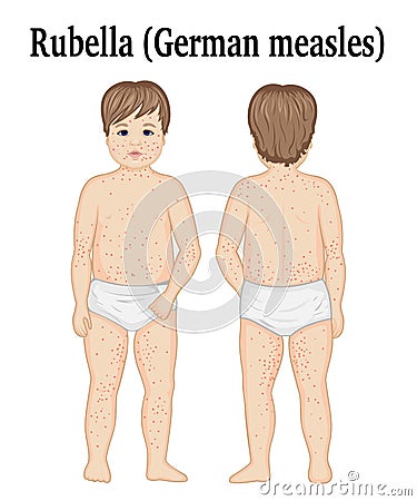 A child with rubella Vector Illustration