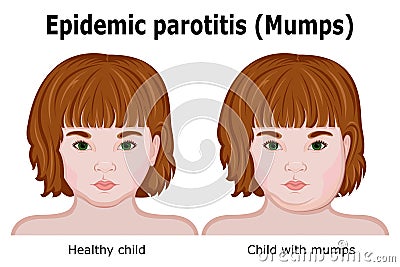 A child with symptoms of mumps Vector Illustration