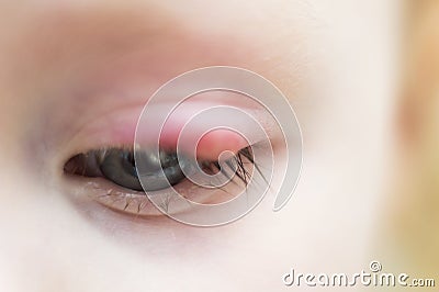 Illness person eye with sty and pus looking into the camera Stock Photo