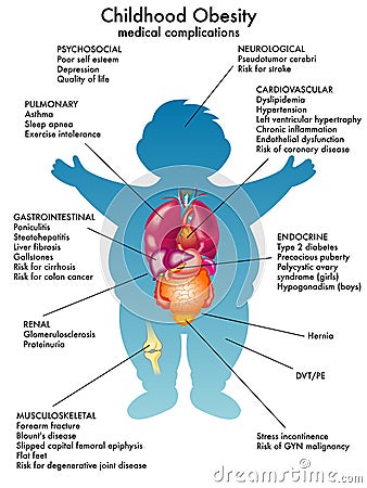 Childhood obesity Vector Illustration