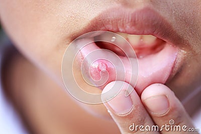 Children with aphtha on lip Stock Photo