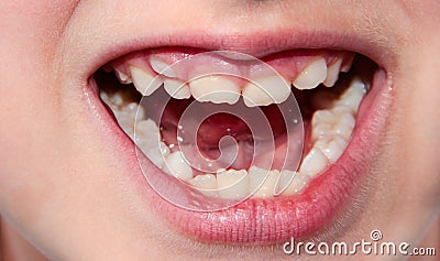 Children`s teeth. The molar grows in the second row. Anomalies of tooth growth Stock Photo