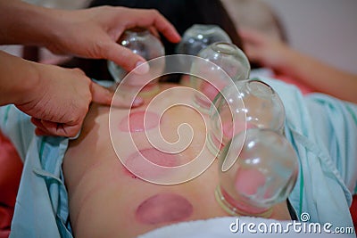 Chinese medicine science is a method of treatment using Cupping. Stock Photo