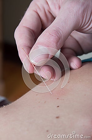 Chiropractor acupuncture needle of female patient Stock Photo