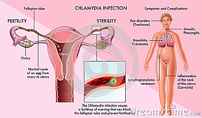 Chlamydia infection in females Vector Illustration