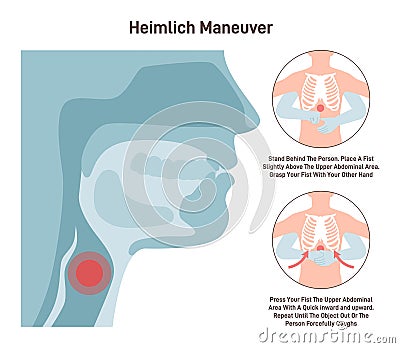 Choking first aid. Heimlich maneuver procedure to remove a foreign Vector Illustration