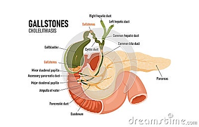 Cholelithiasis, cholecystitis. Formations in the gallbladder. Blockage of the bile duct. Pancreas. Stock Photo