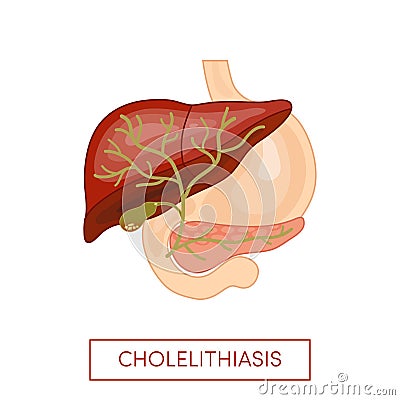 Cholelithiasis - gallstone disease Cartoon Illustration