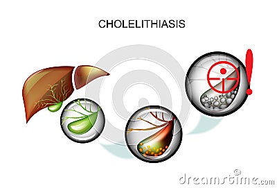 Cholelithiasis. hepatic colic Vector Illustration