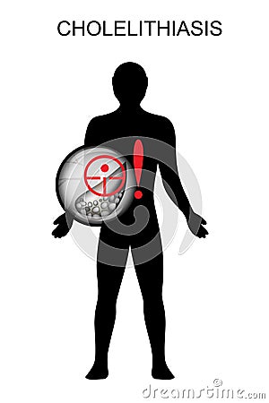 Cholelithiasis. hepatic colic Vector Illustration