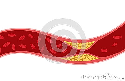 Cholesterol artery thrombosis micro vascular desease. Arteriosclerosis blood vector atherosclerosis risk Vector Illustration