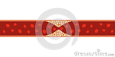 Cholesterol artery thrombosis micro vascular disease. Arteriosclerosis blood atherosclerosis risk Stock Photo