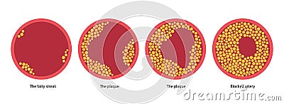 Cholesterol and atherosclerosis Vector Illustration