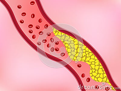 Cholesterol in blood vessel blocking flow of blood Vector Illustration