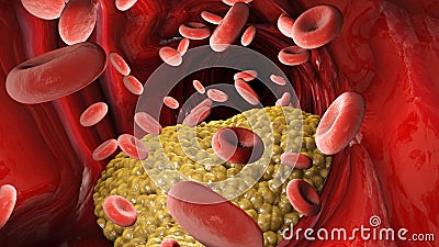 Cholesterol formation, fat, artery, vein. Red blood cells, blood flow. Narrowing of a vein for fat formation Stock Photo