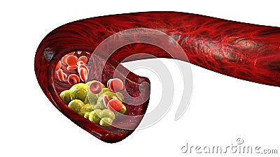 Cholesterol formation, fat, artery, vein, heart. Red blood cells, blood flow. Narrowing of a vein for fat formation Stock Photo